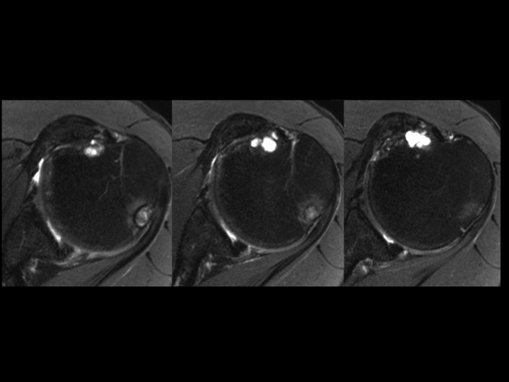 Figure 3 for case Os Subscapularis vs Old Lesser Tuberosity Avulsion